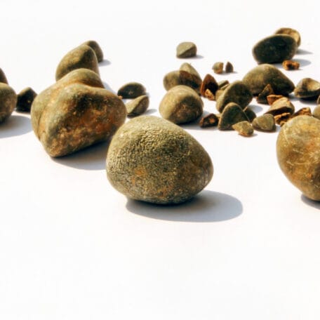 Hormone Therapy Increases Risk of Gallstones