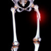 No Osteoporotic Fracture Benefit From Statins