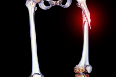 No Osteoporotic Fracture Benefit From Statins