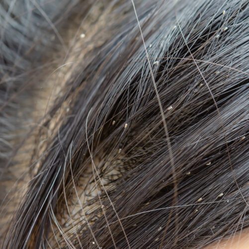 Ick! Head Lice