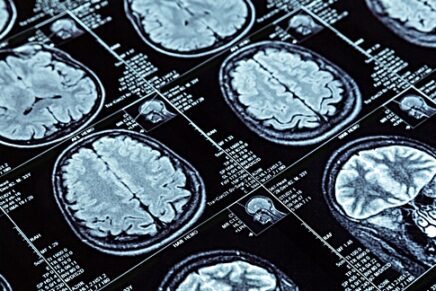 brain scans after ECT and The Persistent Mysteries of Electroconvulsive Therapy