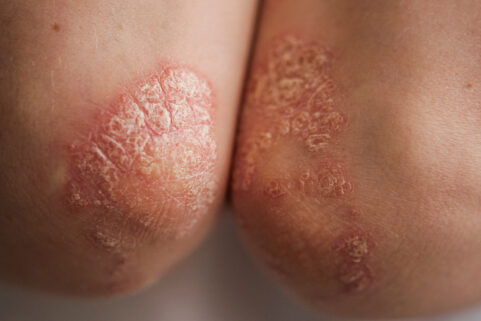 What You Should Know Before Taking Psoriasis Drugs