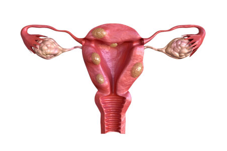 FDA Reiterates Warning Against Power Morcellation For Fibroids