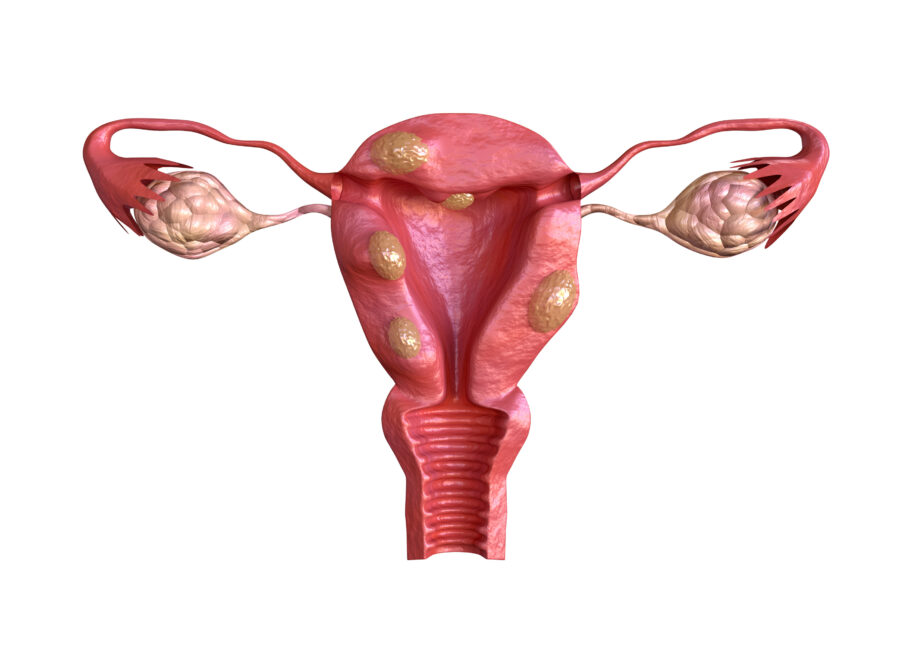 FDA Reiterates Warning Against Power Morcellation For Fibroids