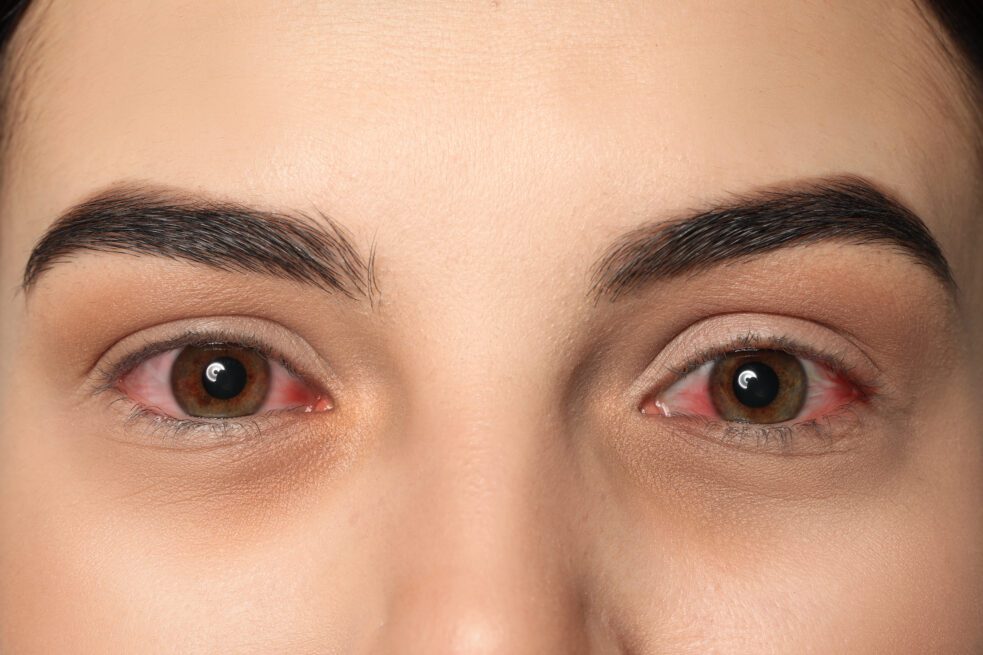 Fish Oil Pills Don’t Help Dry Eye