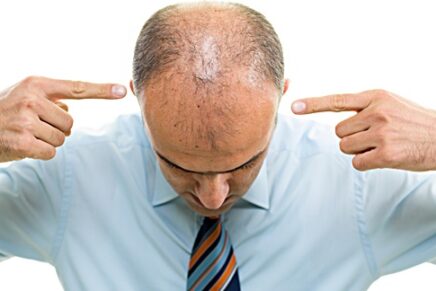 Drugs that can cause hair loss, balding man