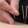 Acupuncture: Fast Facts