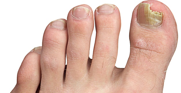 What Are The Best Toenail Fungus Treatments? - Scripps Health