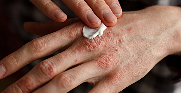 Here S What You Need To Know About Treating Eczema