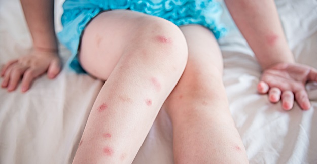 What Are the Best Treatments for Bug Bites?