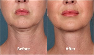 Chin Fat Haters Rejoice Over Kybella