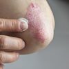 New Psoriasis Med Demonstrates Efficacy, Safety Over Long Term