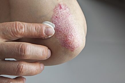 New Psoriasis Med Demonstrates Efficacy, Safety Over Long Term