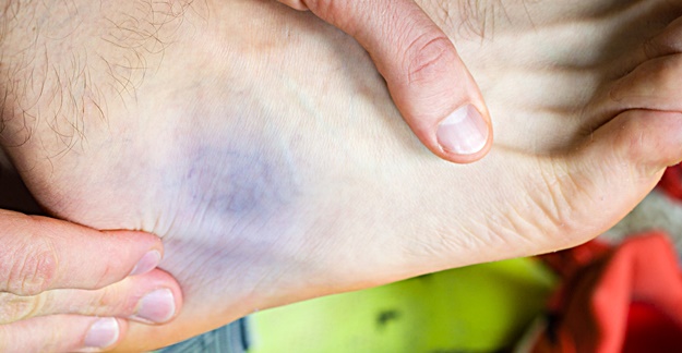 Opioid Prescribing Relatively High for Sprained Ankles