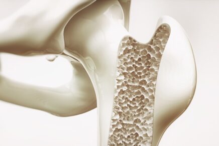 No Bones About It: Treating Osteoporosis and Bone Loss Without Medication