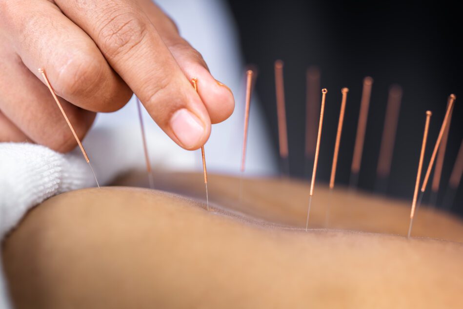 Acupuncture Is Proving Effective - Research Round Up