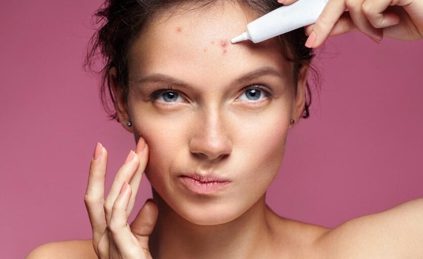 Foods to Combat Acne: What to Eat to Prevent Pimples