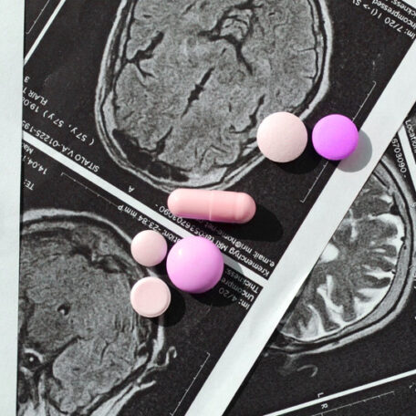 Side Effects of Anti-Epileptic Drugs: What You Should Know