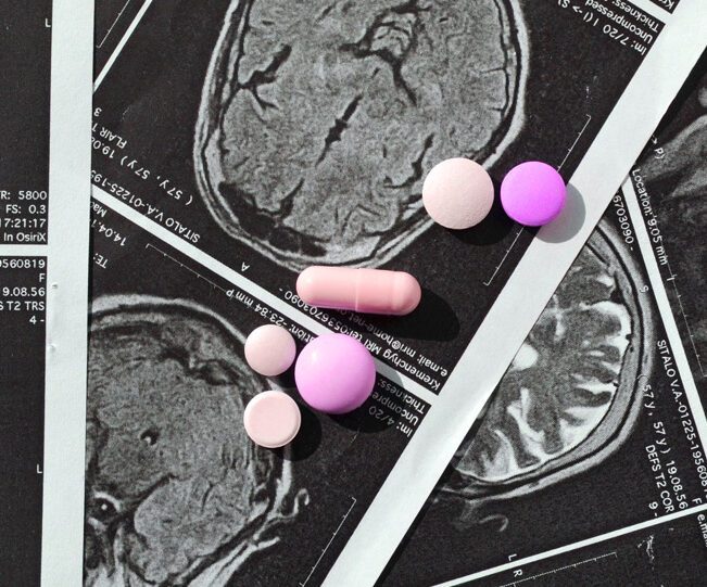 Side Effects of Anti-Epileptic Drugs: What You Should Know