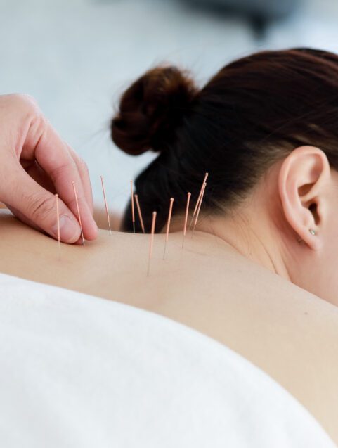 Acupuncture Can Help Alleviate Pain, Nausea, Insomnia and More