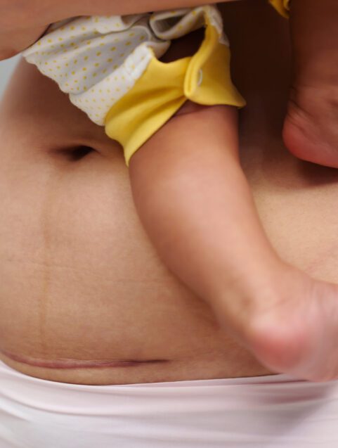 Debate: Blood Thinner For Women After C-Sections