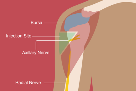 shoulder pain vaccine