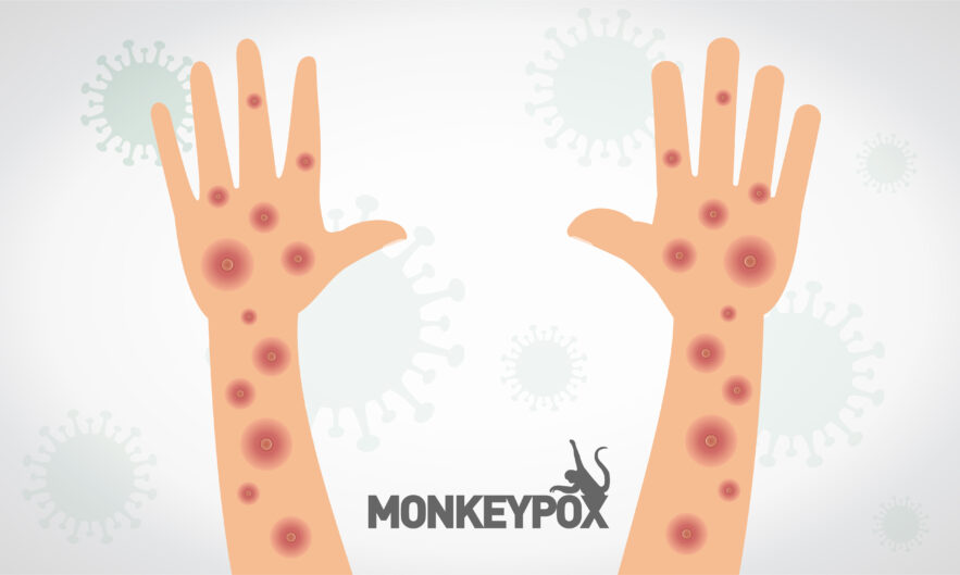 Monkeypox on Hands & Arm Graphic