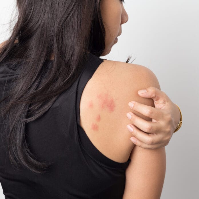 What Causes Hives And How Dangerous Can They Be?