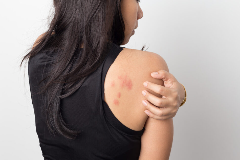 What Causes Hives And How Dangerous Can They Be?