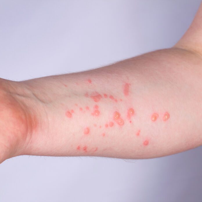 What To Know About Mpox