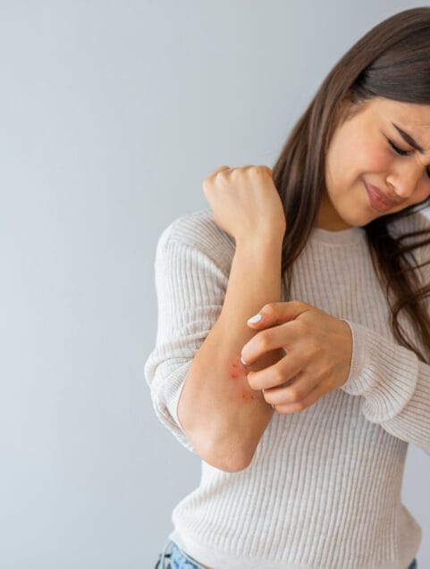 4 Easy Homemade Salves and Balms for Eczema and Dry Skin Relief