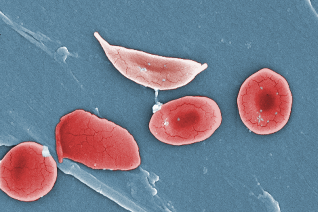 A Sickle Cell Drug That Was Hyped In Headlines Is Now Suspected Of Harming Patients